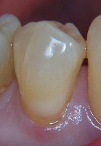 Dental Before & After Photo