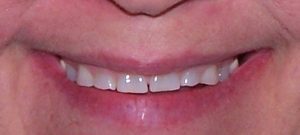 Dental Before & After Photo